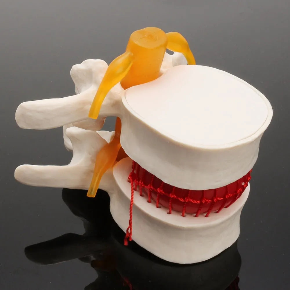 White PVC medical demonstration model of lumbar intervertebral disc showing herniation condition
