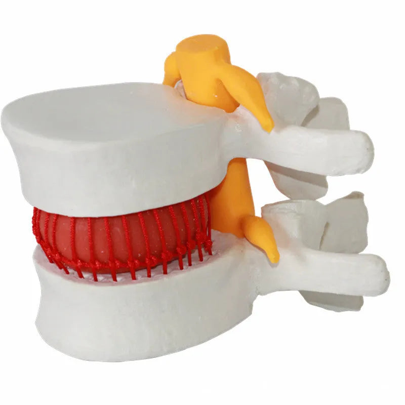 White PVC medical demonstration model of lumbar intervertebral disc showing herniation condition