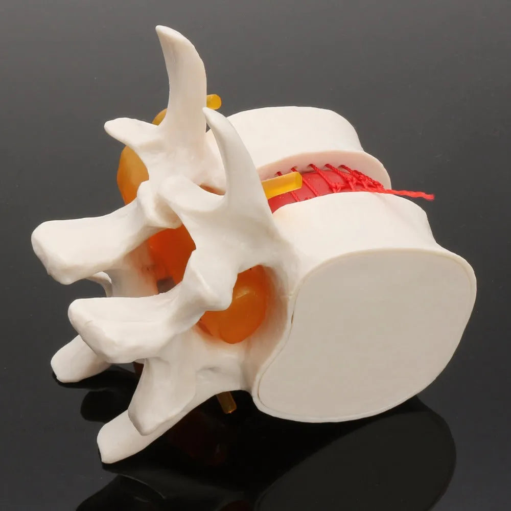 White PVC medical demonstration model of lumbar intervertebral disc showing herniation condition