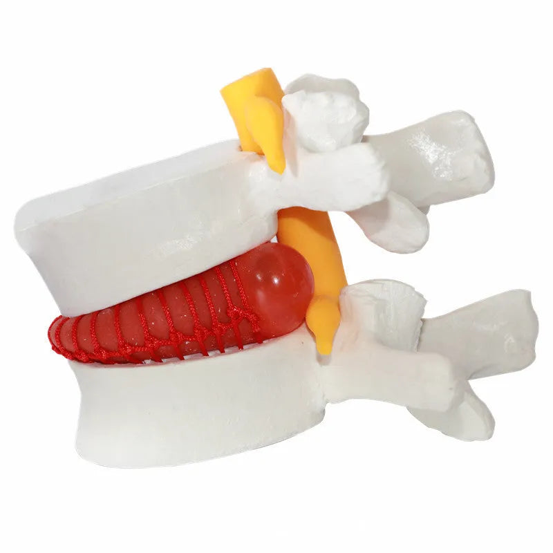 White PVC medical demonstration model of lumbar intervertebral disc showing herniation condition