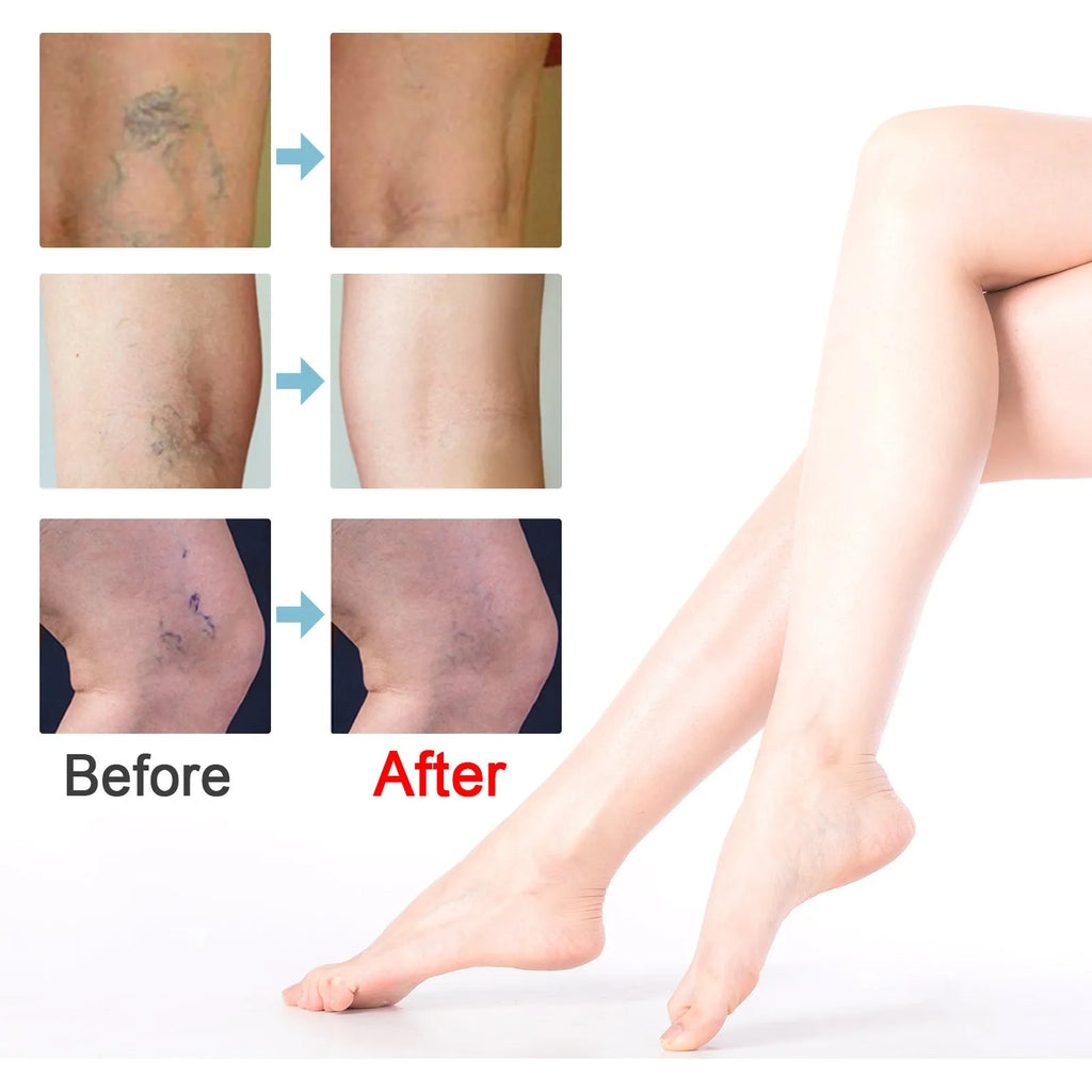 20g tube of unscented vein repair cream for varicose vein relief targeting green tendon bulges