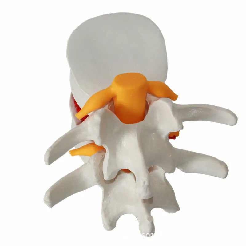 White PVC medical demonstration model of lumbar intervertebral disc showing herniation condition