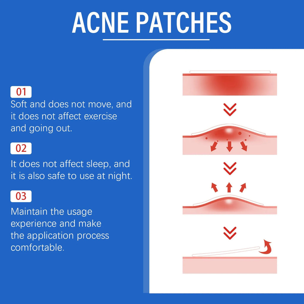 216 hydrocolloid acne patches with tea tree oil and vitamin E for blemish treatment