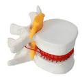 White PVC medical demonstration model of lumbar intervertebral disc showing herniation condition