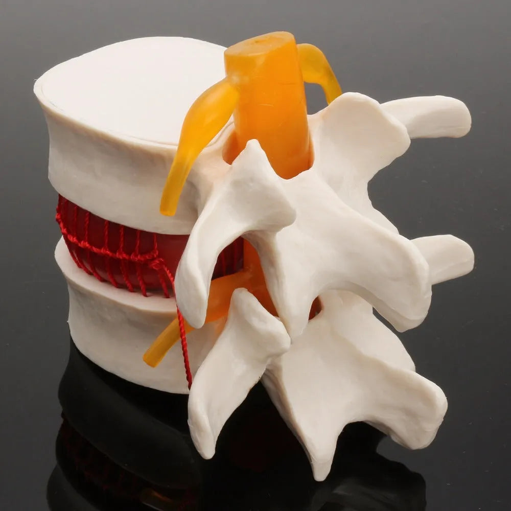 White PVC medical demonstration model of lumbar intervertebral disc showing herniation condition