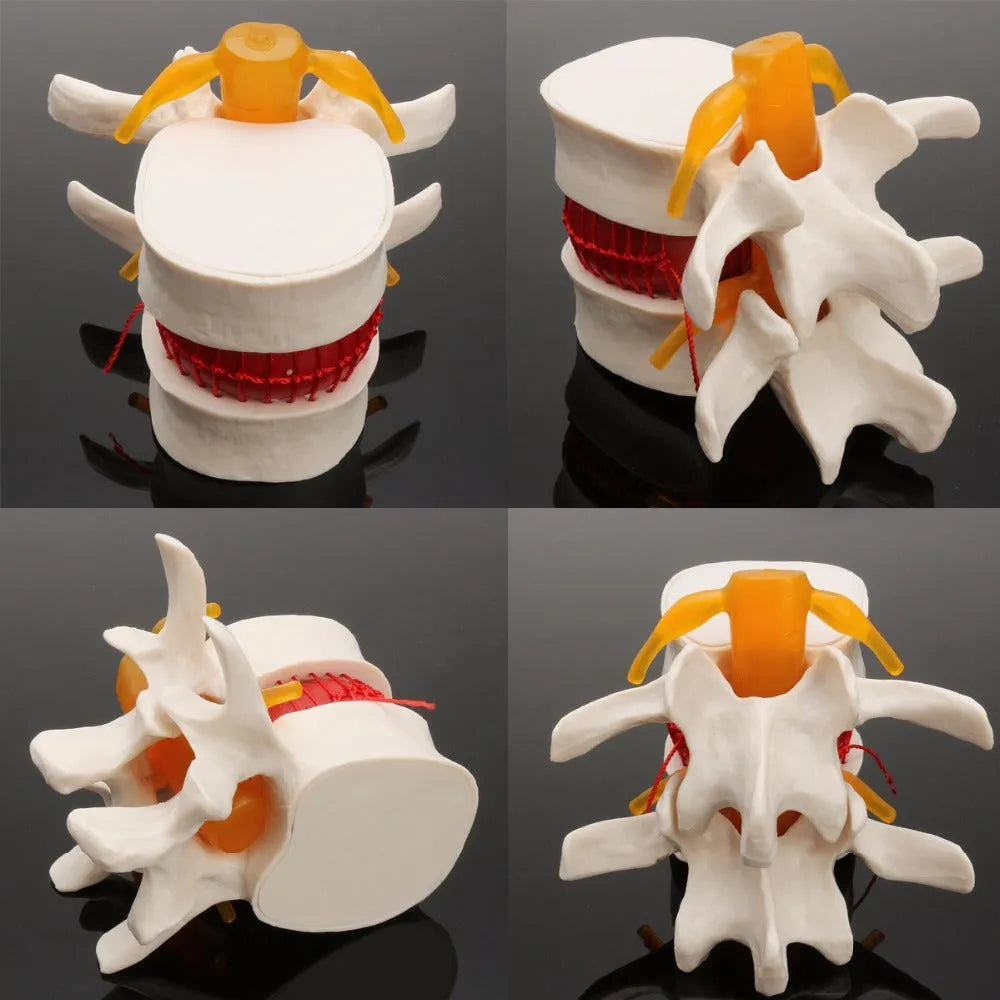 White PVC medical demonstration model of lumbar intervertebral disc showing herniation condition